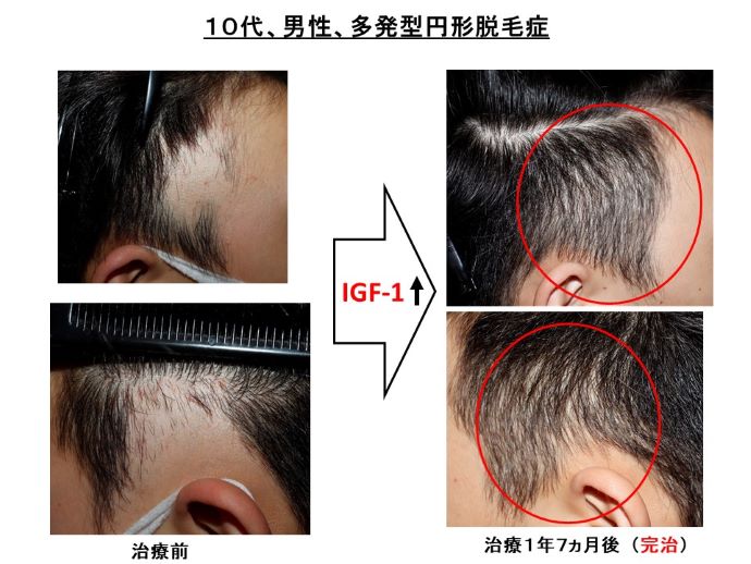 円形脱毛症　病院